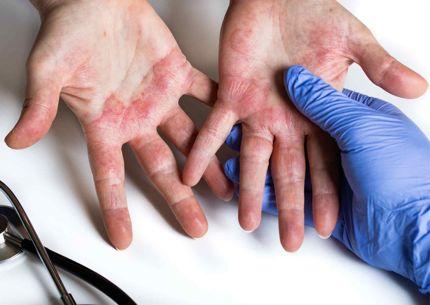 世界アレルギーの日：アトピー性皮膚炎とオリゴフコイダンの新たな役割